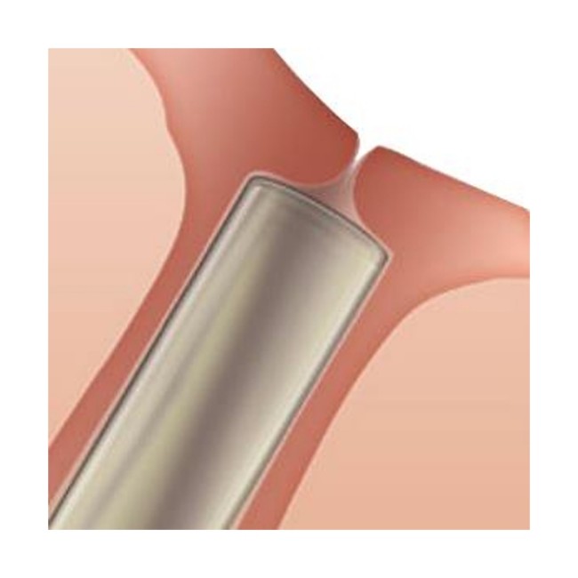 Soft Collagen Plug  0 2 mm